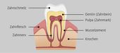 Schemazeichnung eines Zahns mit Schmelz, Dentin und Pulpa