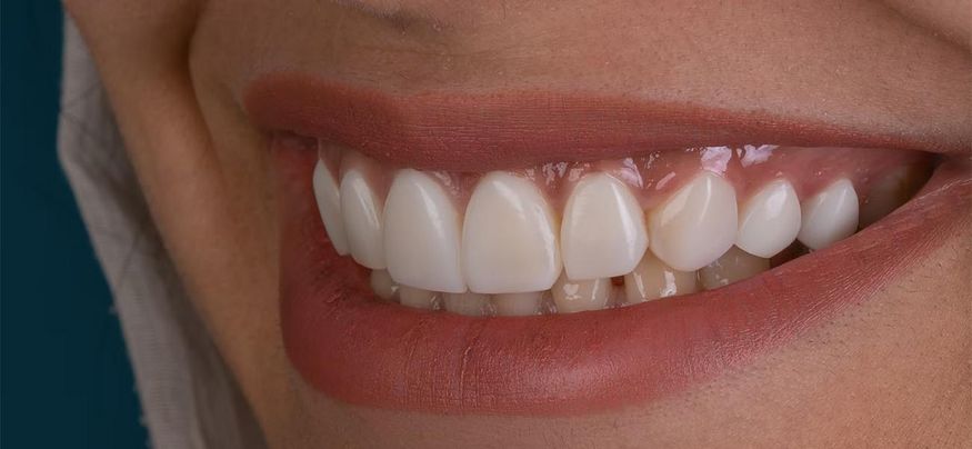 Zahnfleischwucherungen Symptome, Ursachen und Therapie
