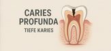 Caries profunda - tiefe Karies vom Zahnarzt erkennen und behandeln lassen