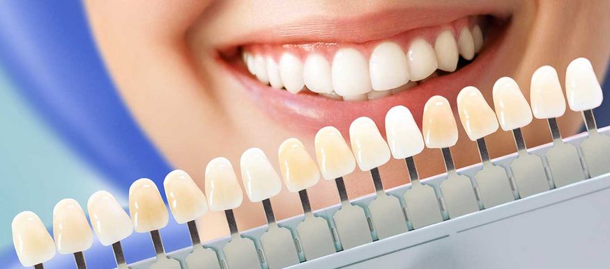 DentNet Ratgeber - Wie werden Zahnfarben bestimmt?