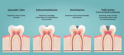 Caries profunda – tiefgehende Karies