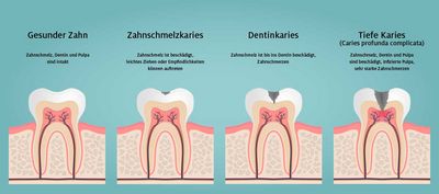 DentNet Ratgeber - Caries profunda