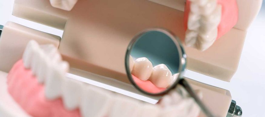 DentNet Ratgeber - Zahnversiegelung mit Microkristallen - Der Dentcoat