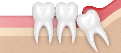 Perikoronitis – Schlupfwinkelinfektion bei teilretinierten Zähnen