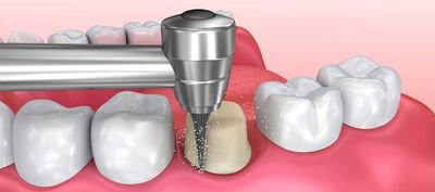 Zahnpräparation: Vorbereitung auf Füllung, Krone oder Brücke