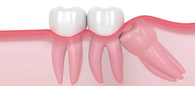 DentNet Ratgeber - Retinierte und verlagerte Zähne