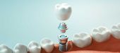 Zahnimplantat mit Implantatkrone im Kiefermodell – Implantat oder Brücke