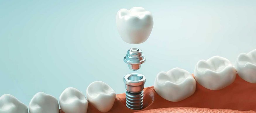 Suprakonstruktion: Zahnersatz auf Implantaten Suprakonstruktion: Zahnersatz auf Implantaten