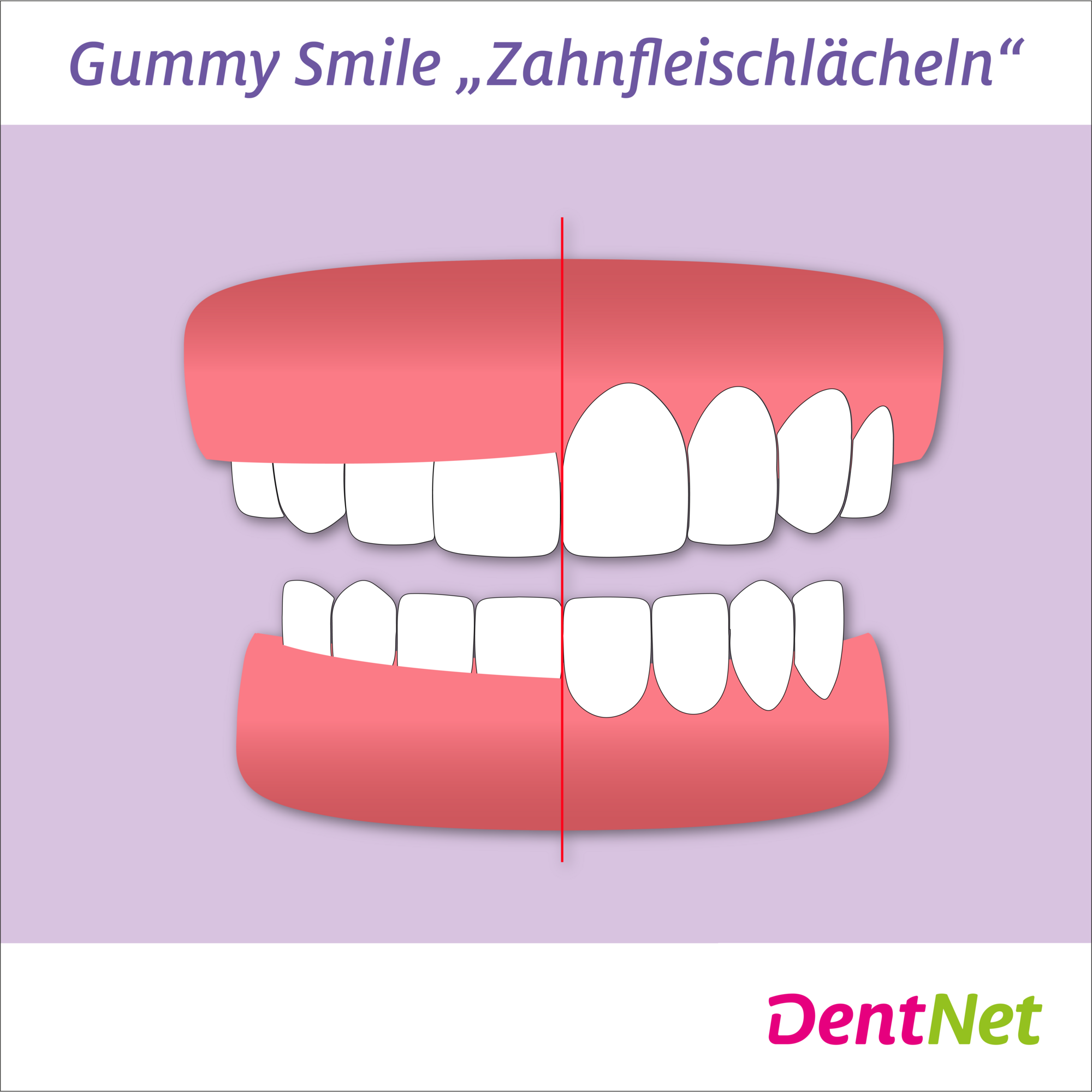 Gummy Smile (Zahnfleischlächeln)