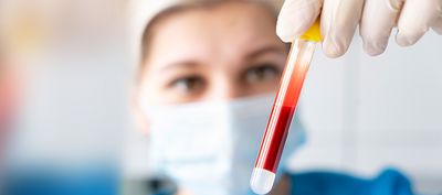Was ist eine Eigenblut-Therapie in der Zahnmedizin? Beschleunigte Wundheilung durch PRF
