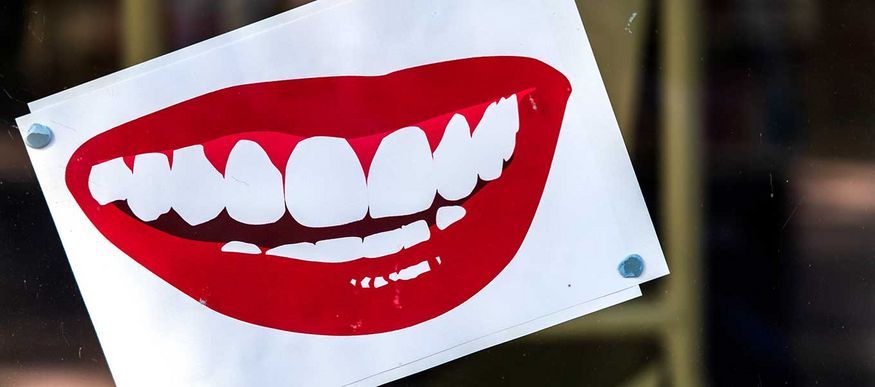 Marylandbrücke – Implantat-Alternative für die Frontzähne Marylandbrücke – Implantat-Alternative für die Frontzähne