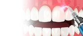 DentNet Ratgeber PACT Photoaktive Chemotherapie
