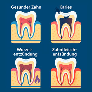 Zahnschmerzen Arten und Ursachen