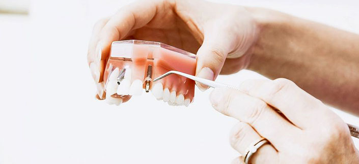 Alles Wichtige zu Implantaten: Behandlung, Kosten, Risiken