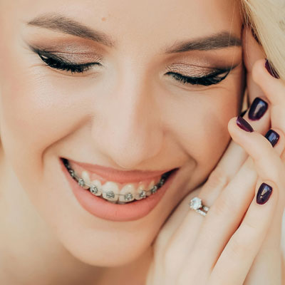 Warum eine Zahnspange für Erwachsene sinnvoll ist