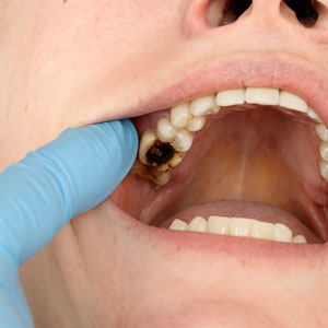 Caries profunda