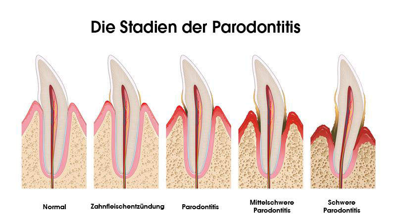 Die Stadien der Paradontitis