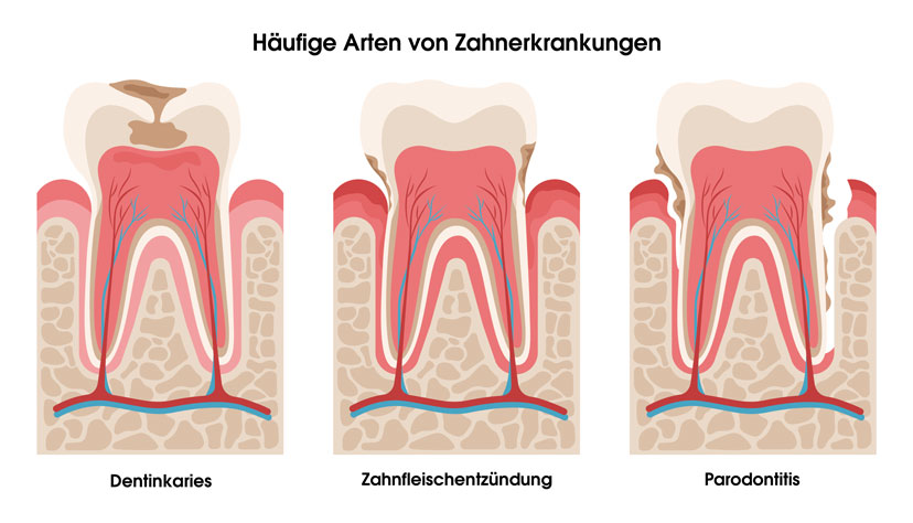 Häufige Arten von Zahnerkrankungen