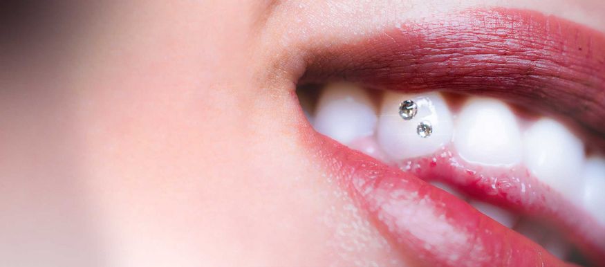 Zahnschmuck: Arten, Anwendung und Pflegehinweise