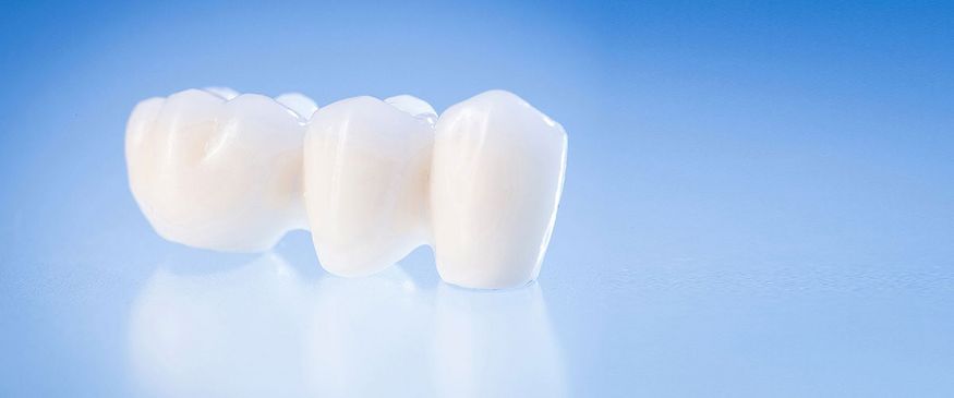 DentNet Ratgeber - Patienten fragen zum Thema Zahnkronen und Brücken