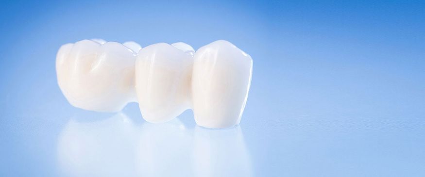 DentNet Ratgeber - Patienten fragen zum Thema Zahnkronen und Brücken DentNet Ratgeber - Patienten fragen zum Thema Zahnkronen und Brücken