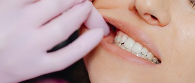 Zahnfleischentzündung (Gingivitis): Ursachen, Symptome und Behandlung