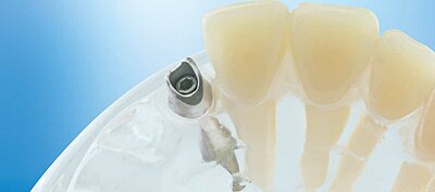 DentNet Ratgeber - Abutments, Stützpfeiler für implantatgetragene Aufbauten