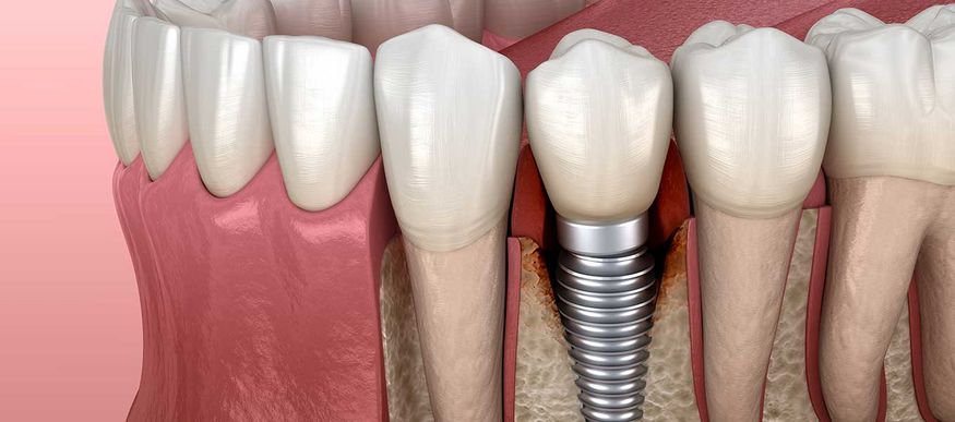 DentNet Ratgeber - Periimplantitis – Entzündung des Implantatbetts