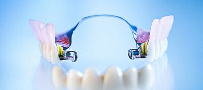 Dentnet Ratgeber - Geschiebeprothese