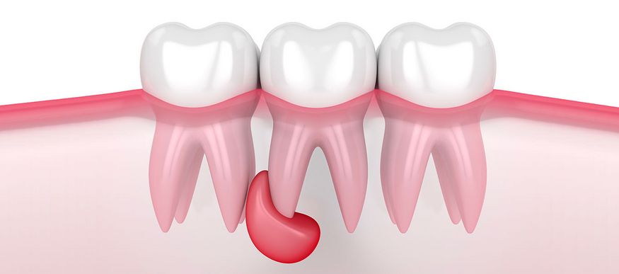DentNet Ratgeber - Zysten im Zahnfleisch oder Kiefer – was tun?