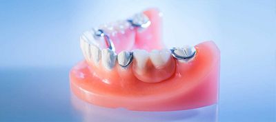 DentNet Ratgeber - Modellgussprothese für fehlende Zähne