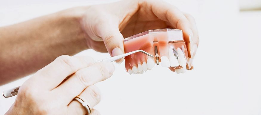 DentNet Ratgber - Zahnimplantate - medizinische Notwendigkeit, Risiken und Kosten