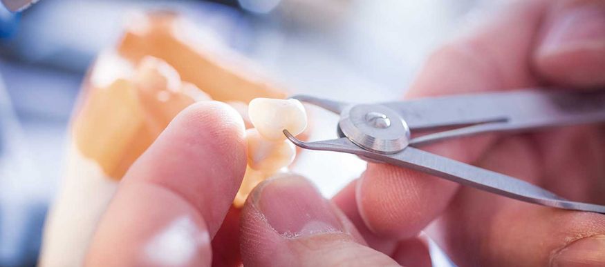 DentNet Ratgeber - festsitzender Zahnersatz DentNet Ratgeber - festsitzender Zahnersatz