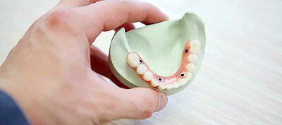 DentNet Ratgeber - All-on-4 Zahnimplantate