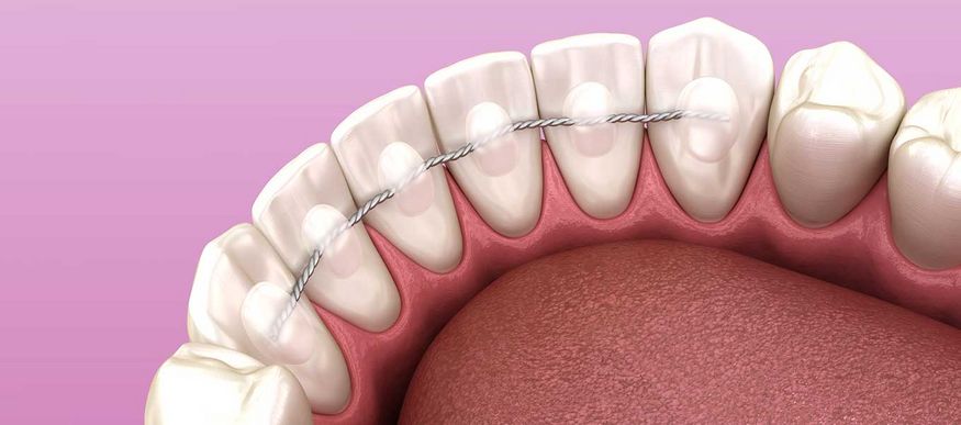 Retainer - der Stabilisator für die Zahnstellung