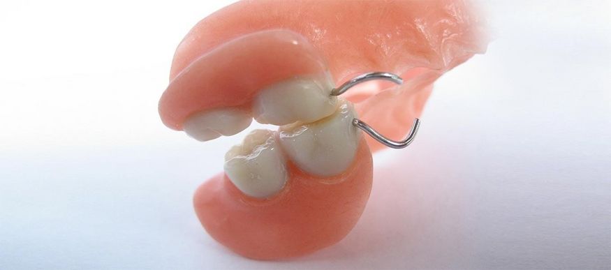 DentNet - Ratgeber, Interimsprothese DentNet - Ratgeber, Interimsprothese