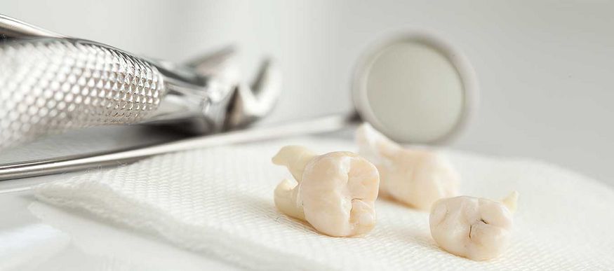 DentNet Ratgeber - Probleme mit den Weisheitszähnen? DentNet Ratgeber - Probleme mit den Weisheitszähnen?