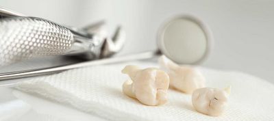 DentNet Ratgeber - Probleme mit den Weisheitszähnen?