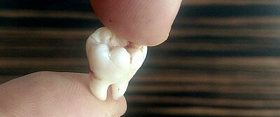 DentNet Ratgber - Backenzähne, Molaren DentNet Ratgber - Backenzähne, Molaren