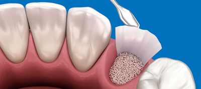 DentNet Ratgeber - Augmentation mit autogenem Dentin