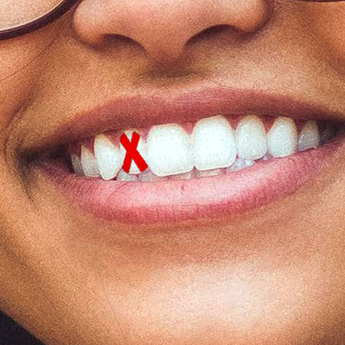 Was genau ist eine dentale Aplasie?