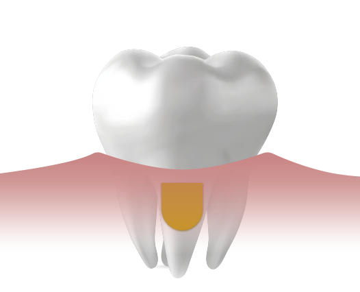 Dentnet Ratgeber CHX-Chip