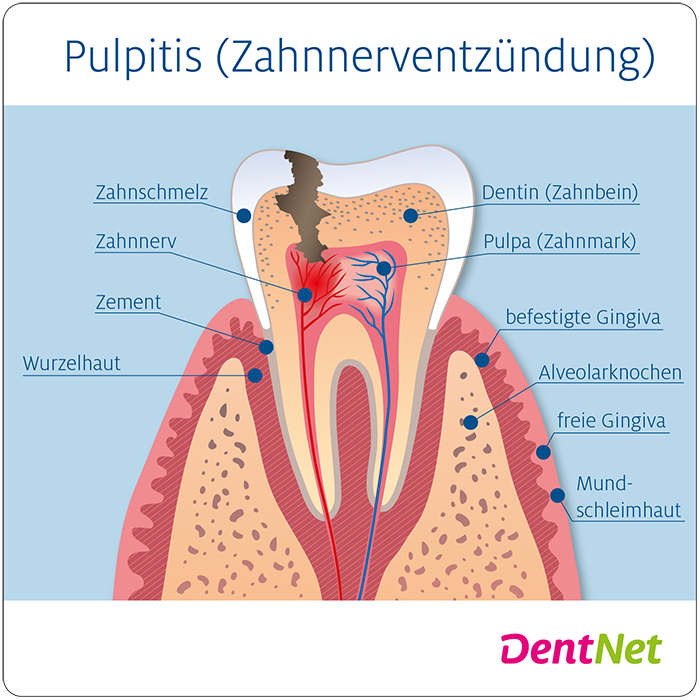 DentNet, Pulpitis, Zahnnerventzündung, Wurzelkanalbehandlung, Wurzelbehandlung Ratgeber
