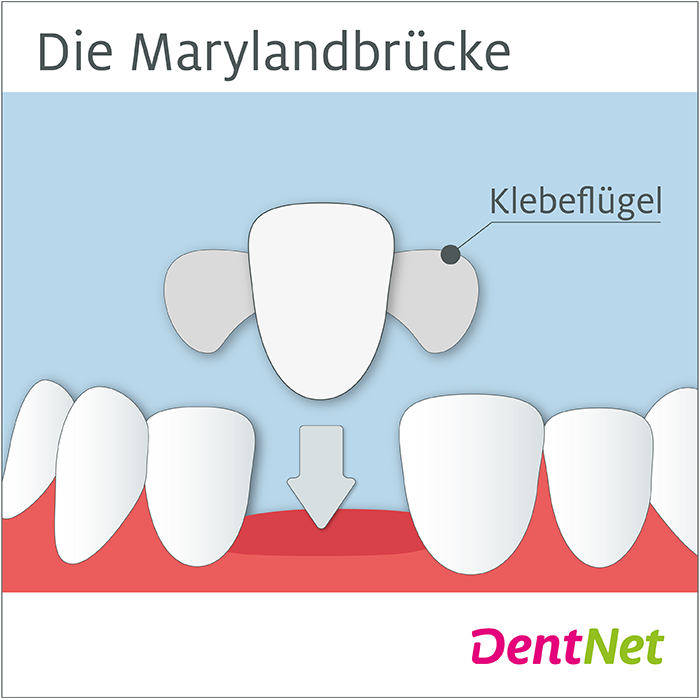 DentNet, Zahnersatz, Zahnimplantat, Brücke, Krone, Frontzähne, Marylandbrücke, Klebebrücke, Adhäsivbrücke