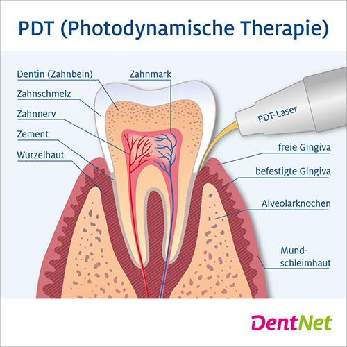 Was ist die Photodynamische Therapie in der Zahnmedizin?