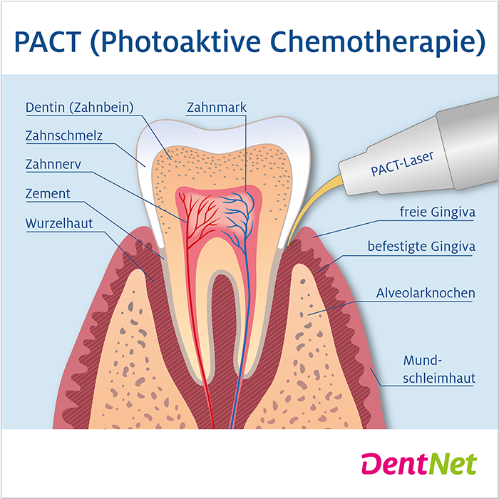 DentNet, PACT, Photoaktive Chemotherapie, Zahnbehandlung, Parodontitis, Zahnbetterkrankungen, Wurzelkanalbehandlung, Wurzelbehandlung, Karies, Kariesbehandlung, Prophylaxe