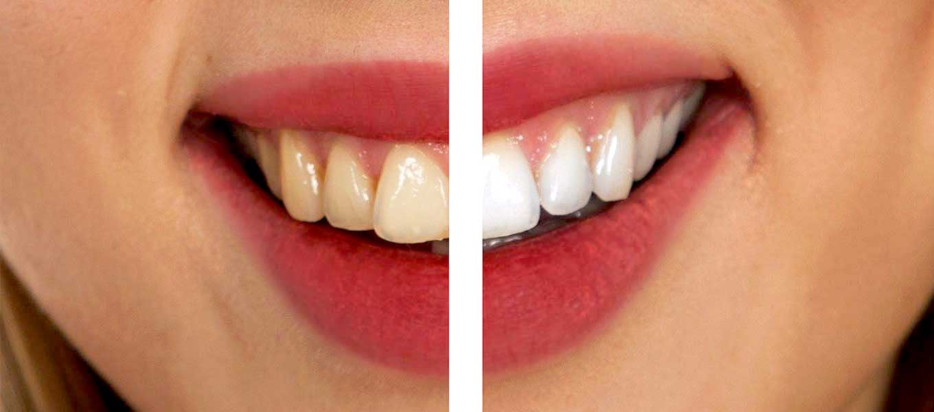 DentNet Ratgeber - Was sind die kosten bei mzahnbleaching?