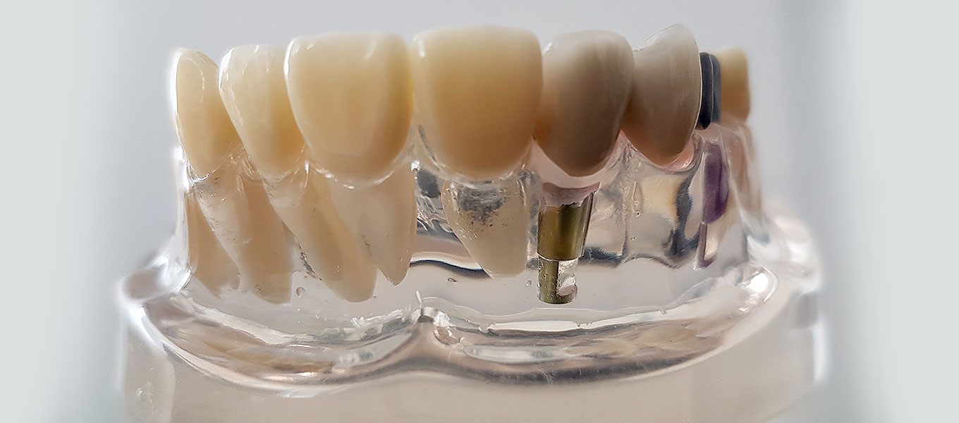 Abutment und Zahnimplantate