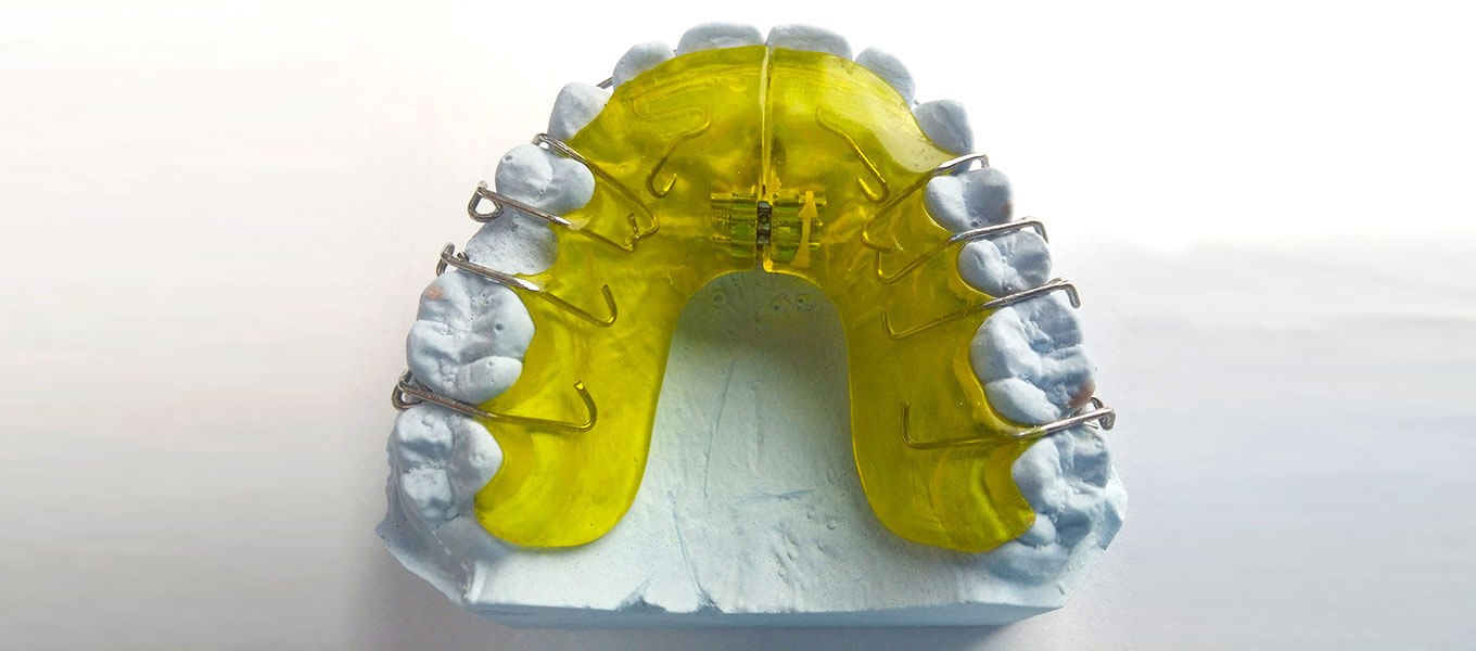 DentNet Ratgber - Zahnspangen und unsichtbare Zahnkorrekturschienen