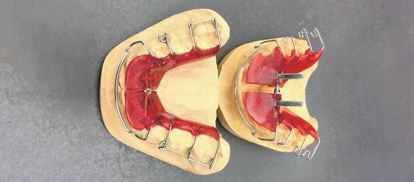 DentNet Ratgeber - Zahnspange, herausnehmbar DentNet Ratgeber - Zahnspange, herausnehmbar